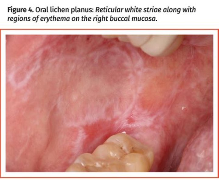 Diffuse Mildly Erythematous Mucosa Unraveled