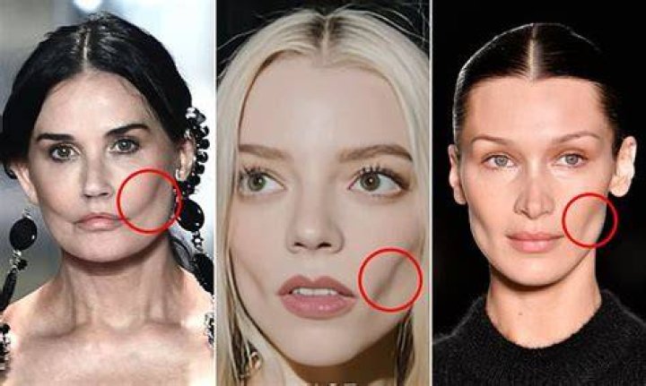 People can't stop talking about the cheek fat removal surgery that's sweeping Hollywood. We asked pl |